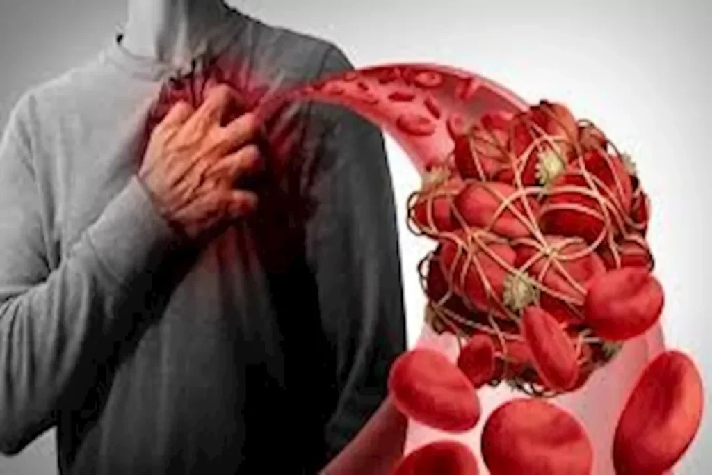 الجلطات في عمر مبكر: كيف يمكن علاجها؟