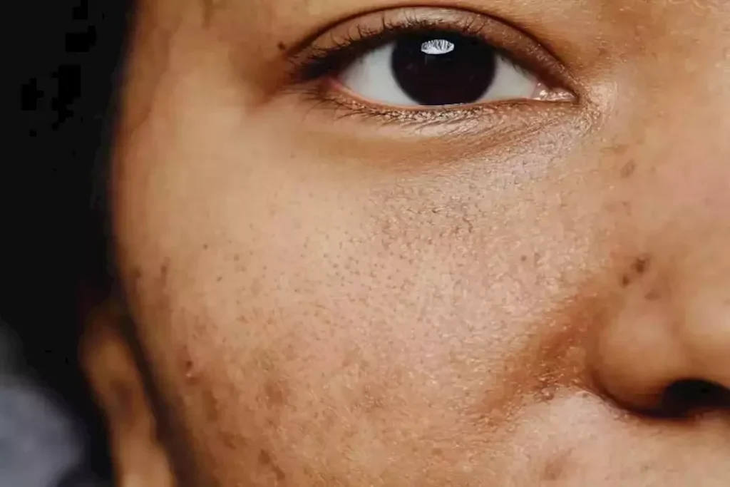 أيهما أفضل لإزالة التصبغات: الأجهزة الطبية أم الكريمات الموضعية؟