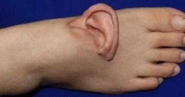 امرأة صينية تعيد تثبيت أذنها بعد 5 أشهر من زراعتها في باطن قدمها