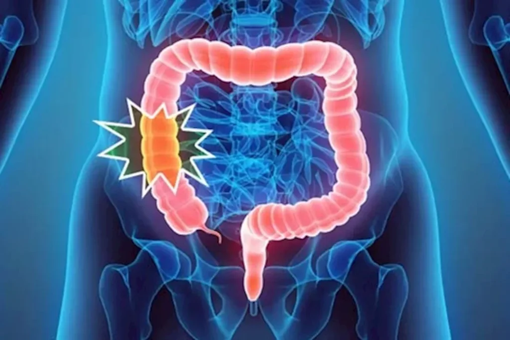 انتبه: 8 أعراض مبكرة لسرطان القولون