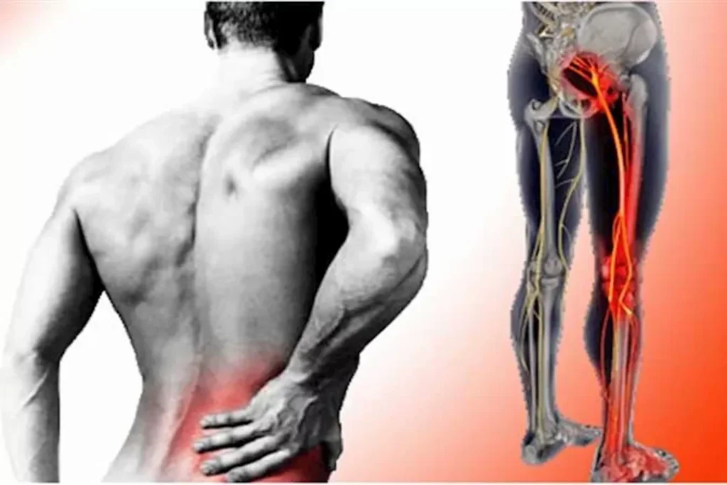 عرق النسا وسقوط القدم: ما العلاقة بينهما؟