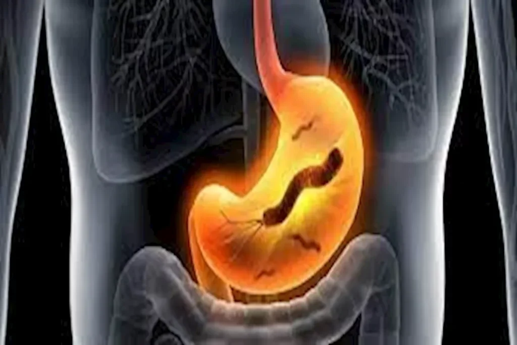 أدق فحص لجرثومة المعدة: البراز أم الدم؟