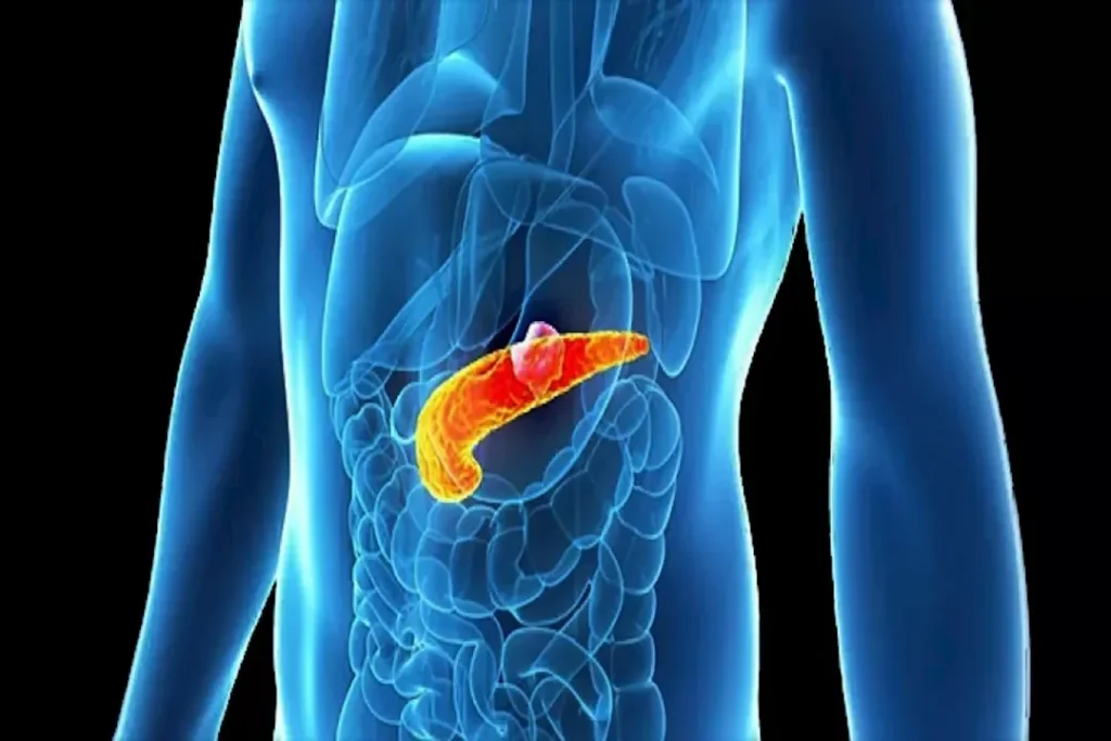 تكيسات البنكرياس: هل تؤدي إلى السكري؟ شرح طبيب