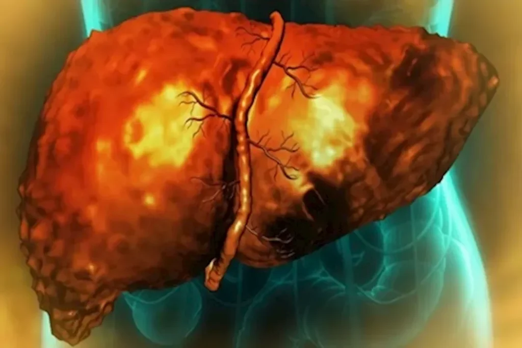 أعراض تلف الكبد: 5 علامات صباحية يجب الانتباه إليها