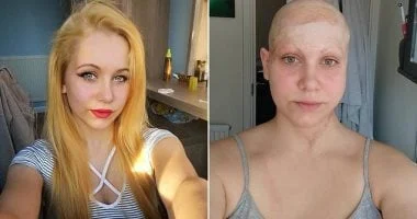 أطفالها لا يعرفونها بدون باروكة بعد حادث عمل