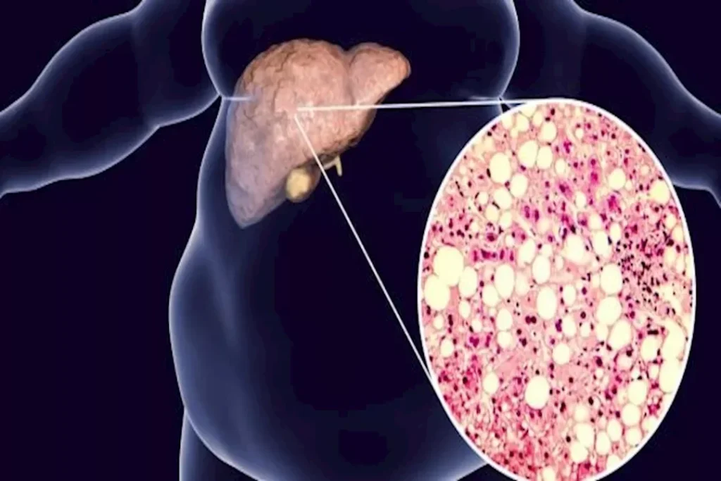 الكبد الدهني: أخطاء غذائية تزيد أعراضه