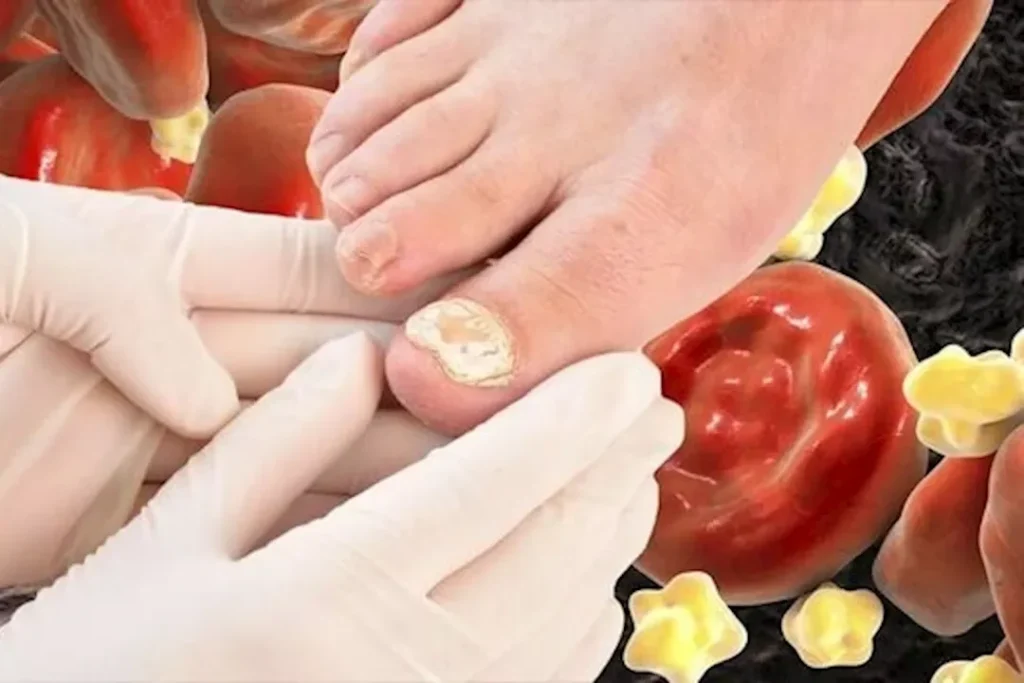 بعد الأربعين: 7 علامات لارتفاع الكوليسترول تظهر في أظافرك