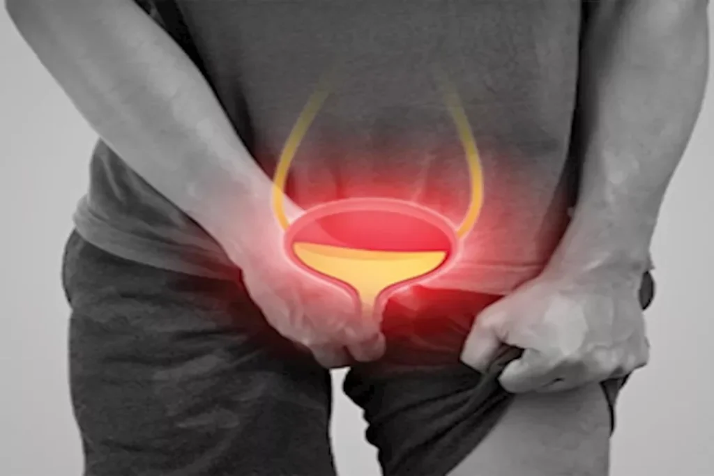 التهاب البروستاتا: طبيب يوضح مدة علاجه وعلامات الشفاء