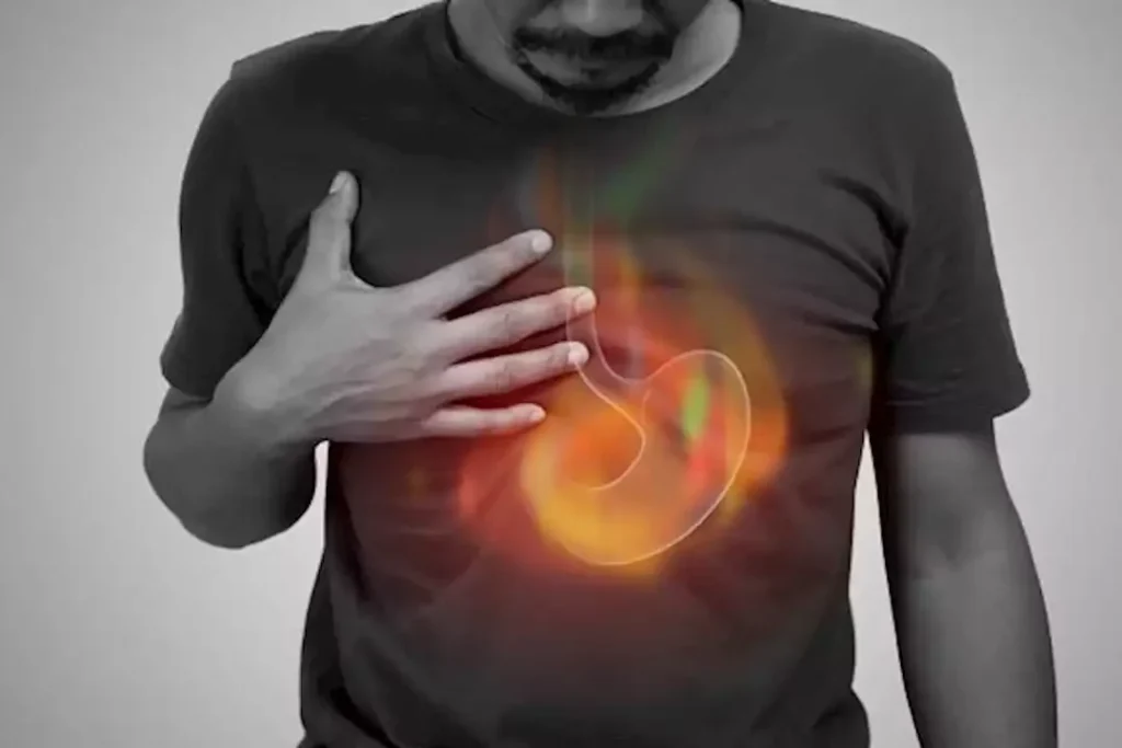 متى يصبح ارتجاع المريء الحمضي خطيرًا؟ المضاعفات المحتملة