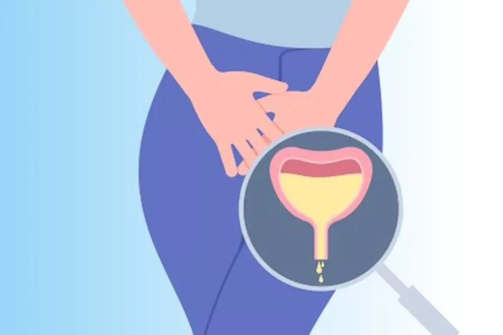 علاج فرط نشاط المثانة طبيعيًا: 6 طرق منزلية لمنع كثرة التبول
