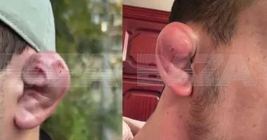 أذن القرنبيط: عمليات التجميل بين رجال روسيا لإظهار القوة
